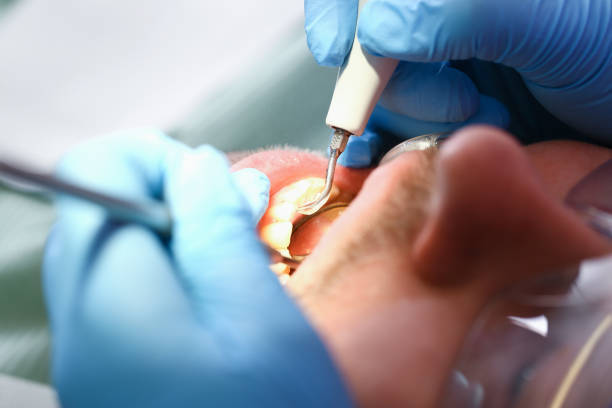 Best Emergency Wisdom Teeth Removal in Ulysses, KS